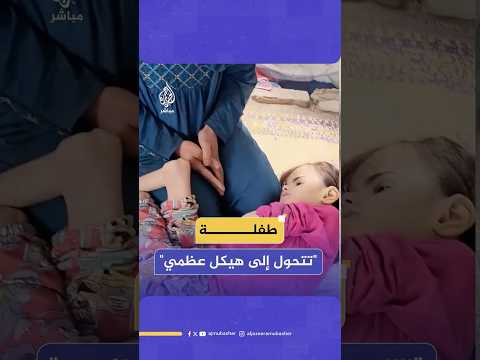 مأساة طفلة فلسطينية تتحول إلى هيكل عظمي جراء الحصار وسياسة التجويع التي يفرضها الاحتلال على قطاع غزة