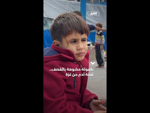 طفولة مشوهة بالقصف..  قصة آدم من غزة