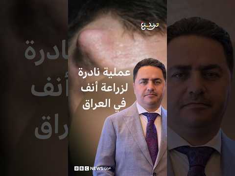 عملية نادرة لزراعة أنف بجبهة مريض في العراق